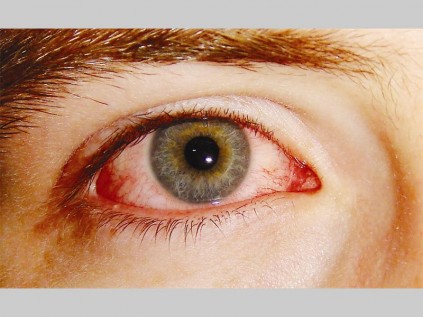 pink-eye_532467815