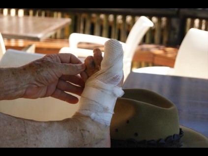 Peter Watson's foot, injured after his encounter with an angry crocodile last Thursday.