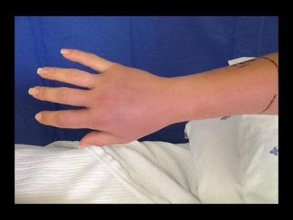 Kira Gibbons' hand on Thursday afternoon which was still very much swollen after the bite from the Stiletto snake.