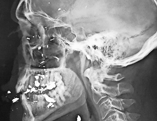 The ex-ray shows extensive damage caused to Ian Johnson's face from being shot in the face.