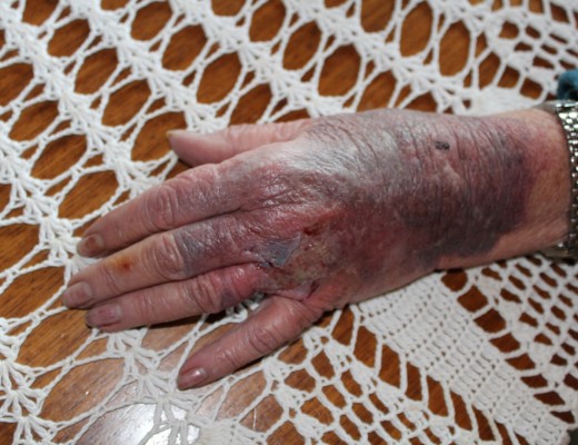 The injuries on Martha’s hand.