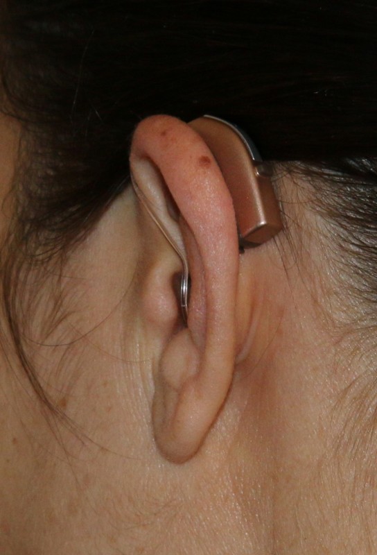 Discreet hearing aids.
