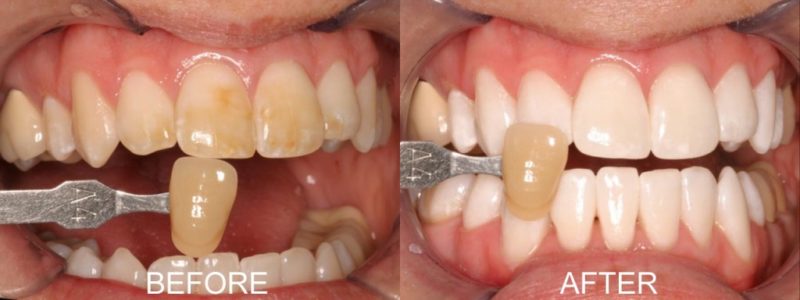 teeth whitening before & After