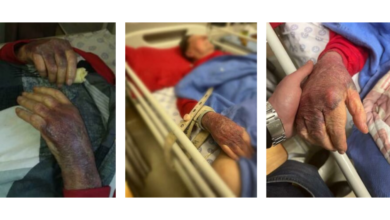 Injuries sustained by an 84-year-old man who was allegedly tied to a Pretoria hospital bed. Photo: Supplied.