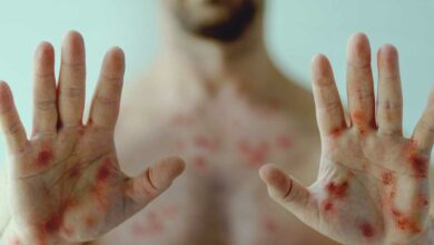 Mpox- Here are symptoms you should look out for