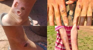 No evidence of myiasis or staphylococcus outbreak in Pretoria