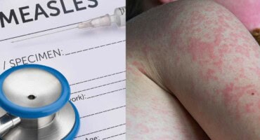 Pretoria sees sharp rise in measles cases