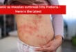 Panic as measles outbreak hits Pretoria - Here is the latest