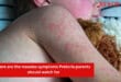 Here are the measles symptoms Pretoria parents should watch for