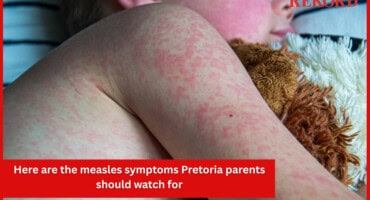 Here are the measles symptoms Pretoria parents should watch for