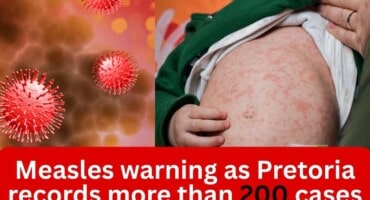 Measles warning as Pretoria records more than 200 cases