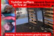 Toddler suffers severe burns in fire at Pretoria crèche