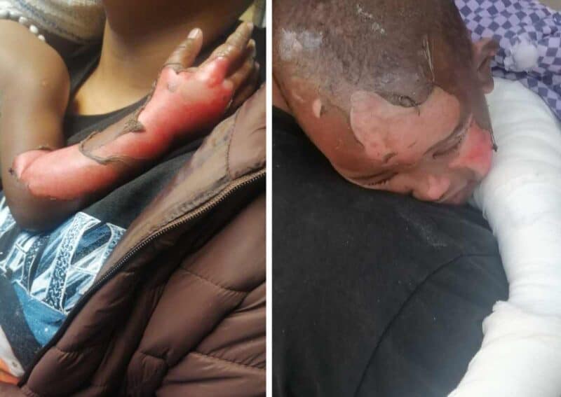 Toddler suffers severe burns in fire at Pretoria crèche