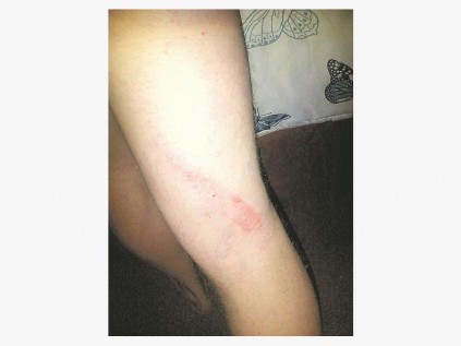 Daar was erge slaanmerke agter op sy been (foto) en op sy arms en nek ook.