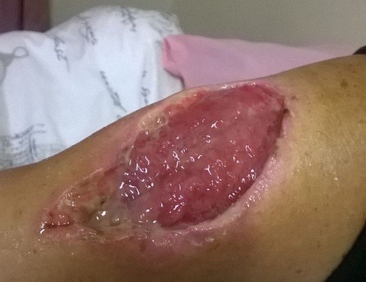 Die sere op 'n Middelburg dwelmgebruiker se arms is so erg dat dit vrese dat sy Krokodil gebruik het, laat opvlam het.