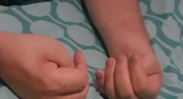 The hands of a young man who had a stroke after an operation.