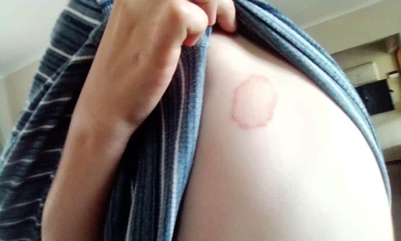 Close-up photo showing a skin lesion on a child’s body.