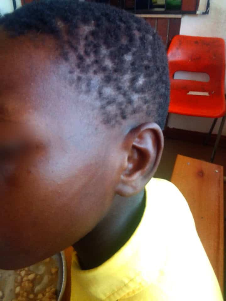 Injured learner from Davel with blurred eyes to protect identity