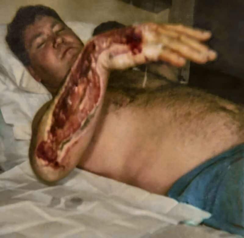 Marius Swart wys die ernstige besering aan sy arm en hand ná ’n ongeluk