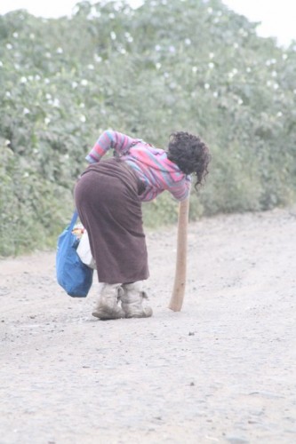 This woman who lived at Secunda dumping site had difficulty walking.