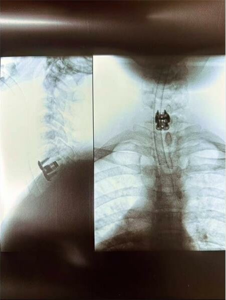 A x - ray of a man's chest and neck.