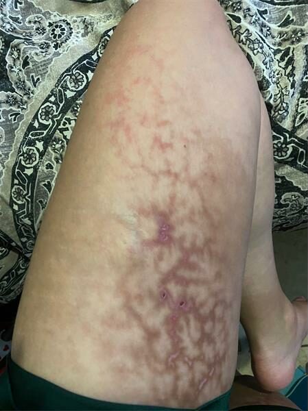 Symptoms of acute cholecystitis on woman's thigh