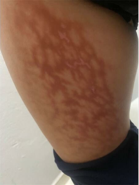 Symptoms of acute cholecystitis on woman's leg