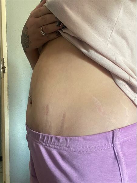 Woman's extended abdomen due to acute cholecystitis