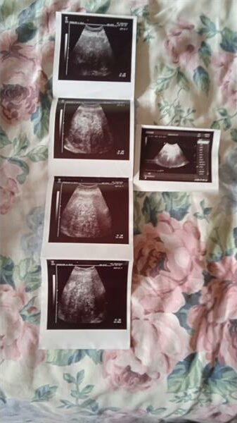 Sonar scans to show an abdominal mass in woman's stomach