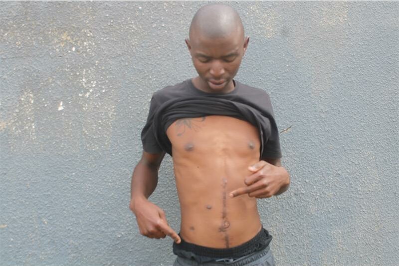 man with pulled up shirt points to scars on his stomach