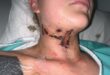 woman with burns in her face