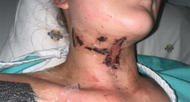 woman with burns in her face