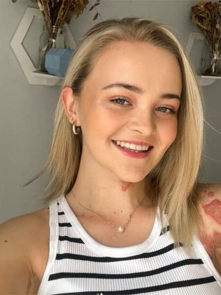 young woman reveals a scars on her neck and arm