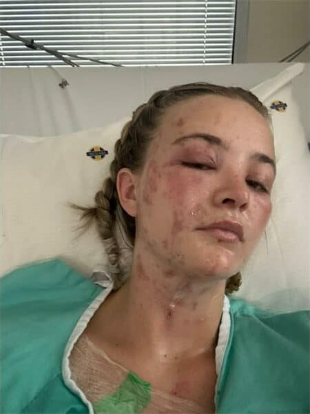 woman with burns in her face and neck