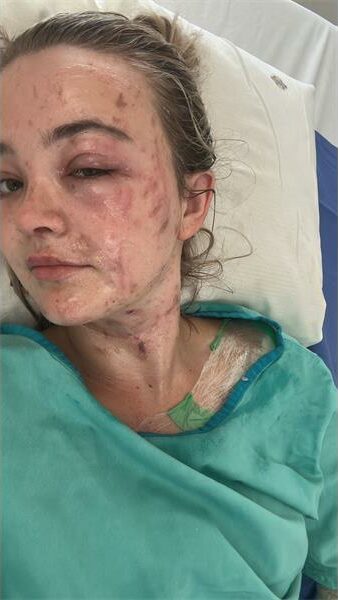 woman with burns in her face and neck