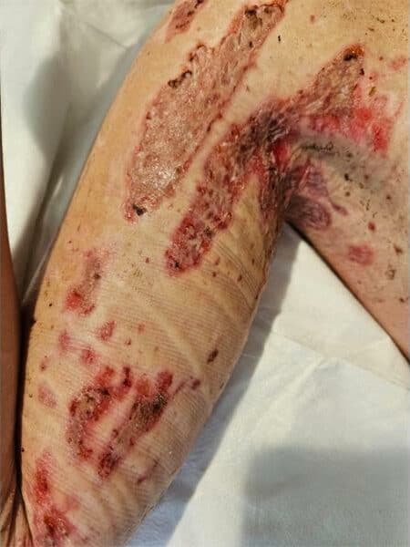 young woman with severe burns to her arms and upper torso