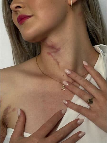 young woman reveals a scar in her neck