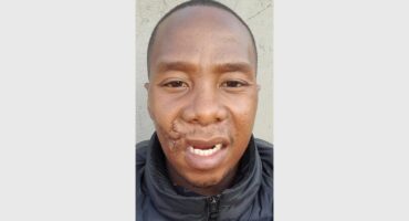 man with facial injuries